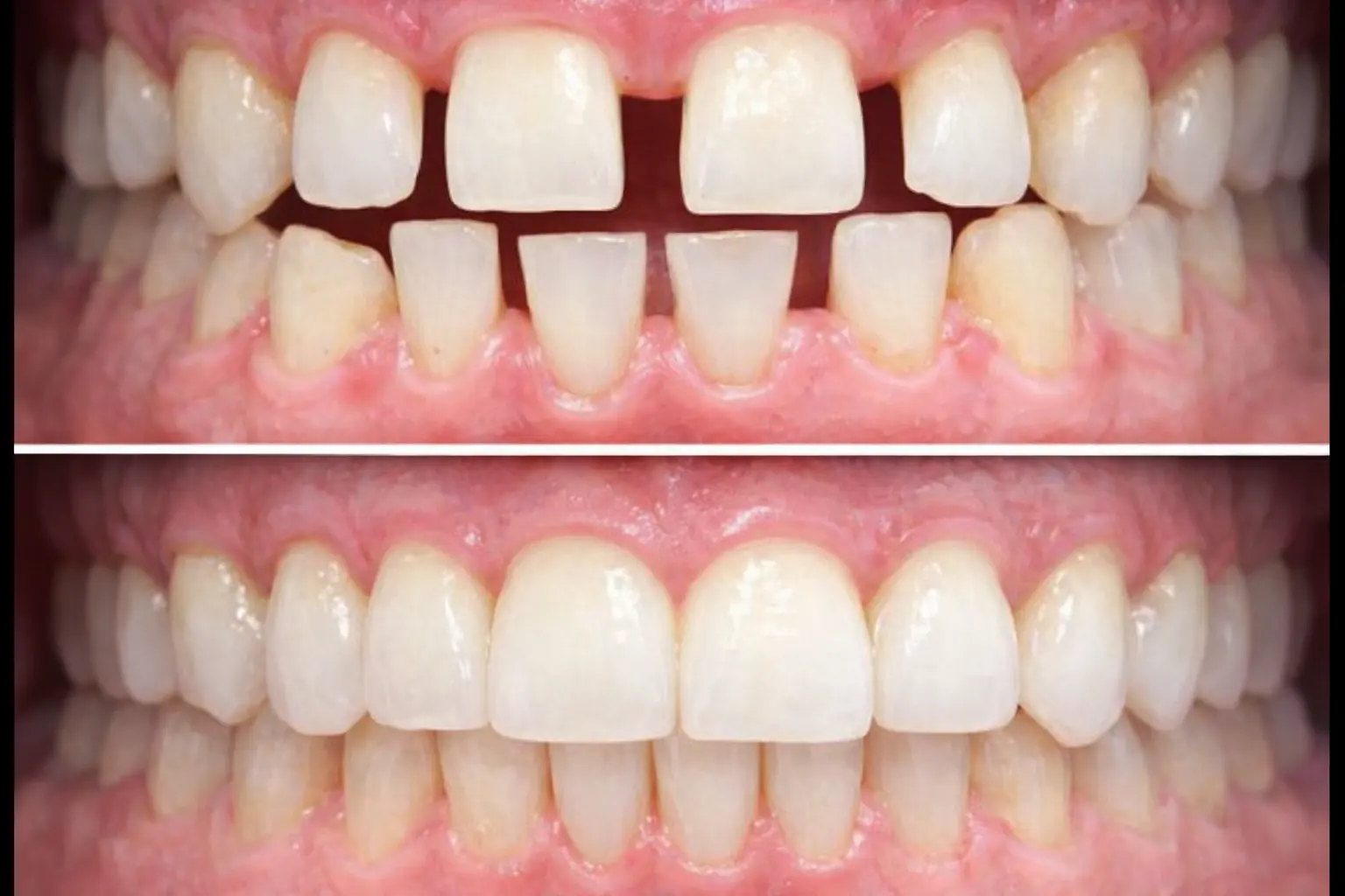 Dental Implants treatment image