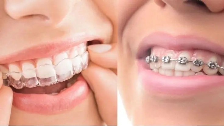Braces & Aligners treatment image
